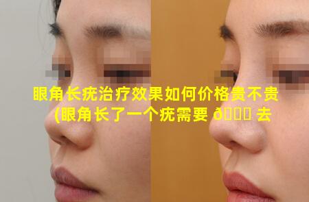 眼角长疣治疗效果如何价格贵不贵(眼角长了一个疣需要 🐛 去 🦋 掉吗)